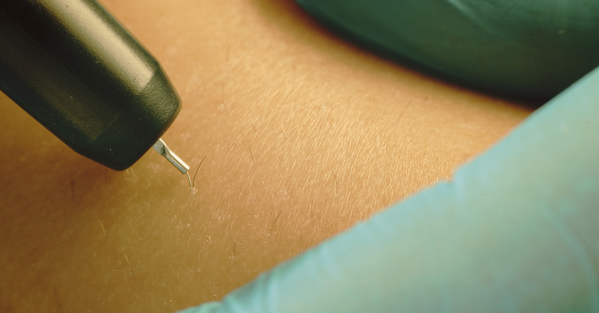 Equipment Checklist for New Electrology Practices: Essential Tools for Success