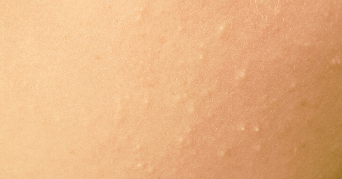A close-up of a person's light-toned skin, showing numerous small, raised, white bumps. The bumps are scattered across the surface, giving the skin a slightly uneven texture.